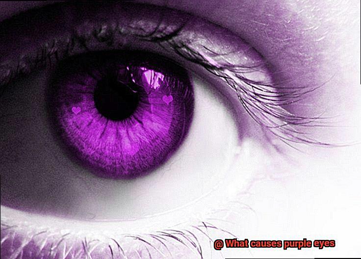 What causes purple eyes-2