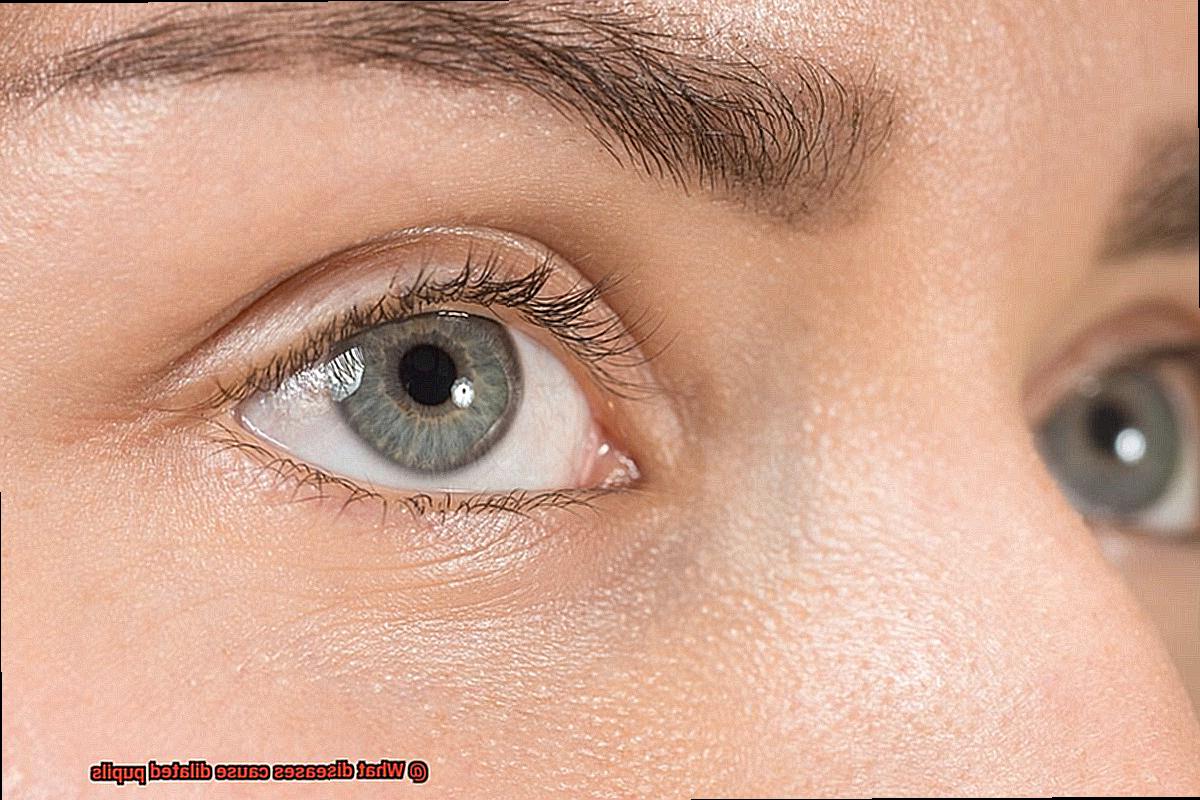 What diseases cause dilated pupils-2
